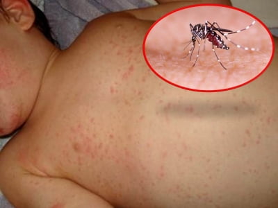 Khi mắc sốt xuất huyết, không được tự ý làm những điều sau