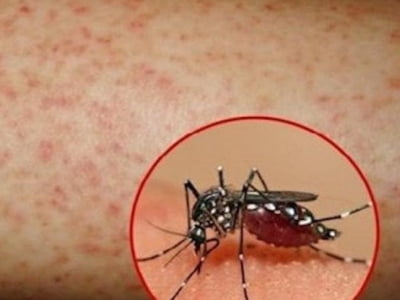 Sốt xuất huyết bùng phát: Cách nào phân biệt COVID-19 và sốt xuất huyết?