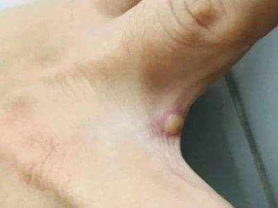 TP.HCM ghi nhận thêm ca đậu mùa khỉ thứ 5 ở quận Tân Bình