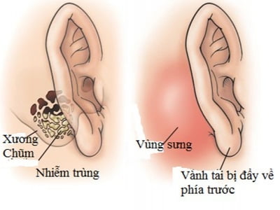 Tai có mùi hôi thối - triệu chứng của nhiều bệnh lý nguy hiểm