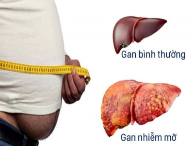 Gan nhiễm mỡ: Nguyên nhân, triệu chứng và cách điều trị 