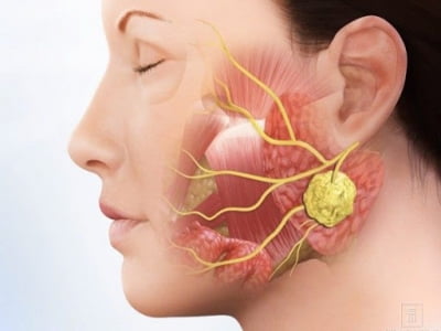 Nhận biết ung thư tuyến nước bọt giai đoạn sớm