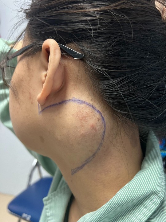 Cắt bỏ khối u ở vị trí nguy hiểm của cô gái 18 tuổi